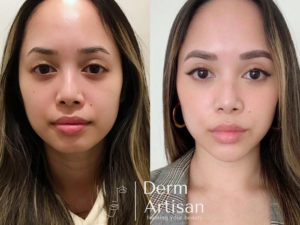 Before and after image of Chin Filler in New York by Derm Artisan