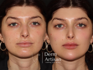 Before and after image of Facial Balancing in New York by Derm Artisan