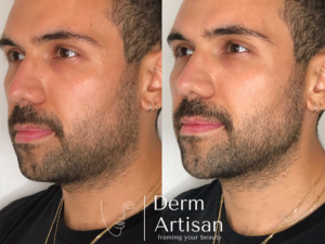 Before and after image of Jawline Filler in New York by Derm Artisan