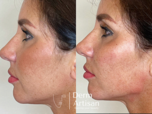 Before and after images of Jawline treatment in New york by Derm Artisan