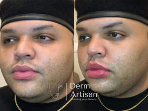 Before and after image of Lip Filler in New York by Derm Artisan