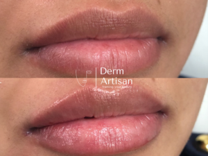 Before and after image of Lip Filler in New York by Derm Artisan