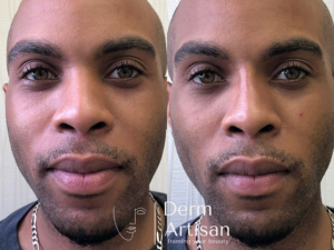 Before and after image of Liquid rhinoplasty in New York by Derm Artisan