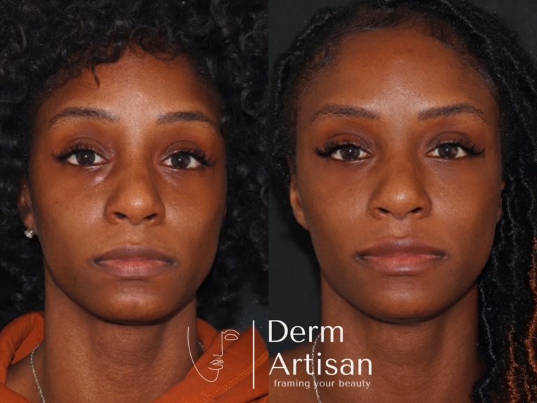 Before and after image of Tear through Treatment in New York by Derm Artisan