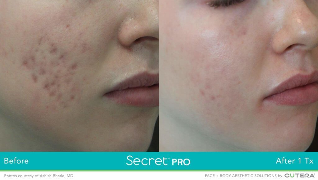 Secret Pro Rf Microneedling Fractional Co Laser Derm Artisan