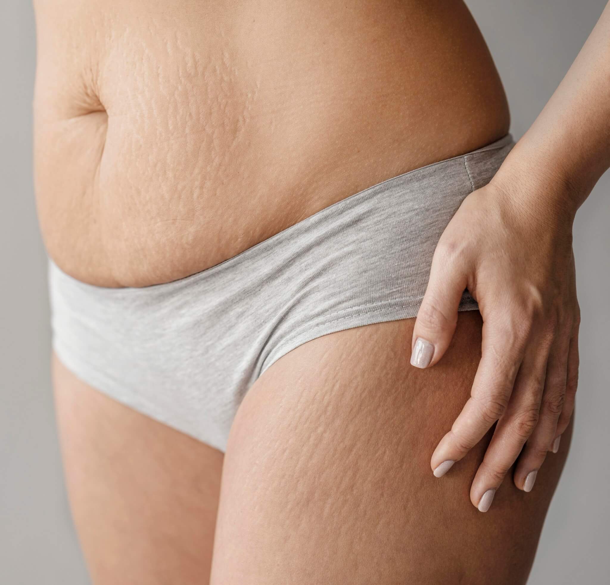 How Often To Book Carboxy Therapy For Stretch Mark Reduction