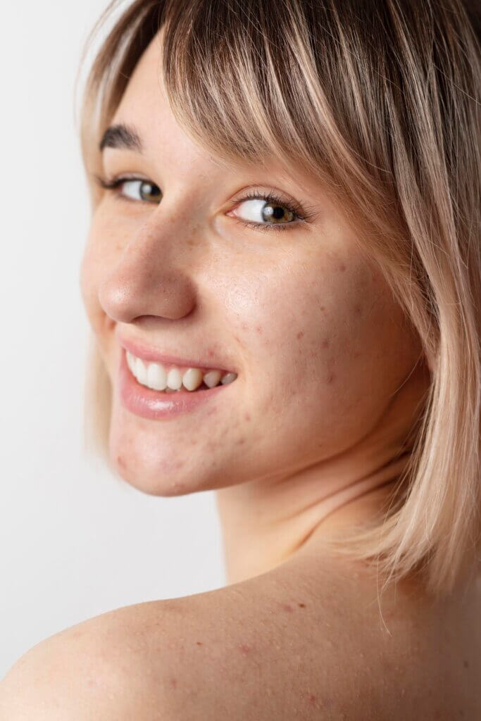 AviClear Acne Laser Treatment in NYC