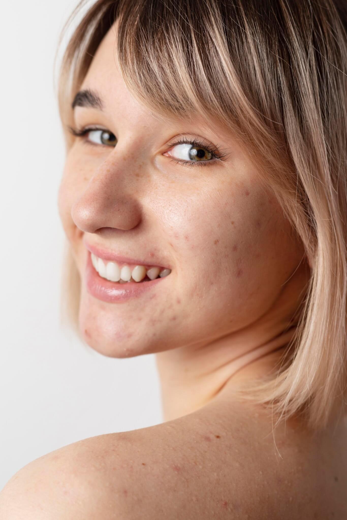 AviClear Acne Laser Treatment in NYC