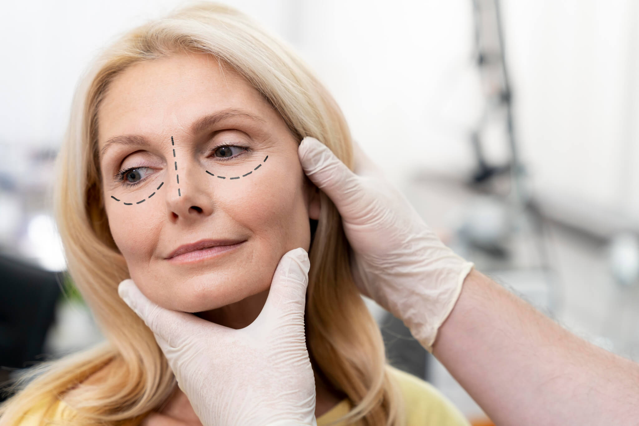 Deep Plane Facelift: Results for Advanced Aging Signs