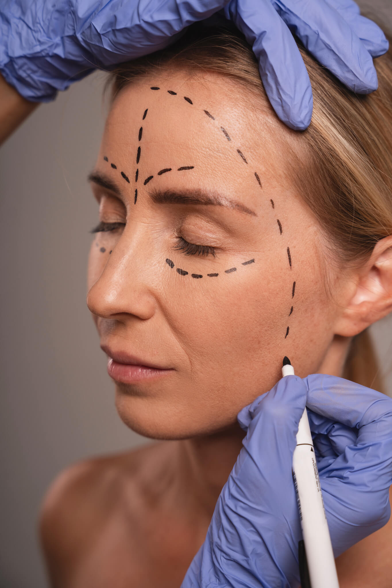 Non-Surgical RF Facelift with Venus Legacy in NYC